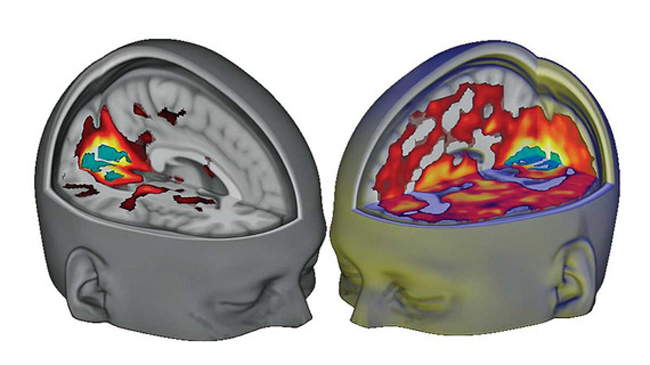 ¿Cómo afecta el LSD al cerebro?